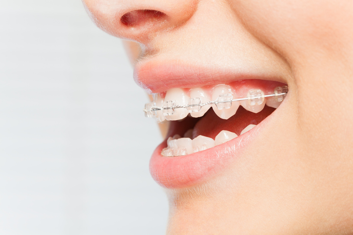 Clear Ceramic Braces: Sophisticated Discretion