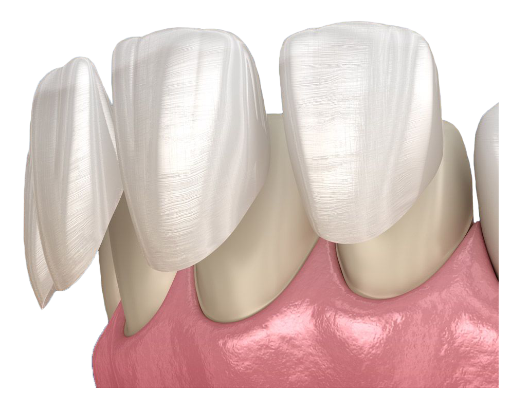veneers