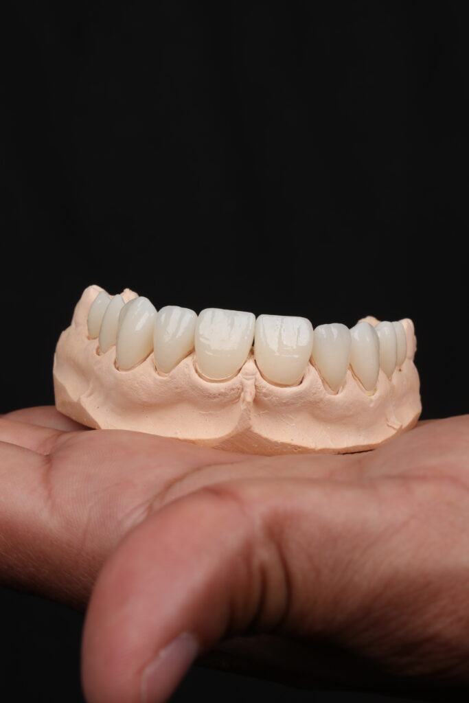 veneers_smiledentalnogales