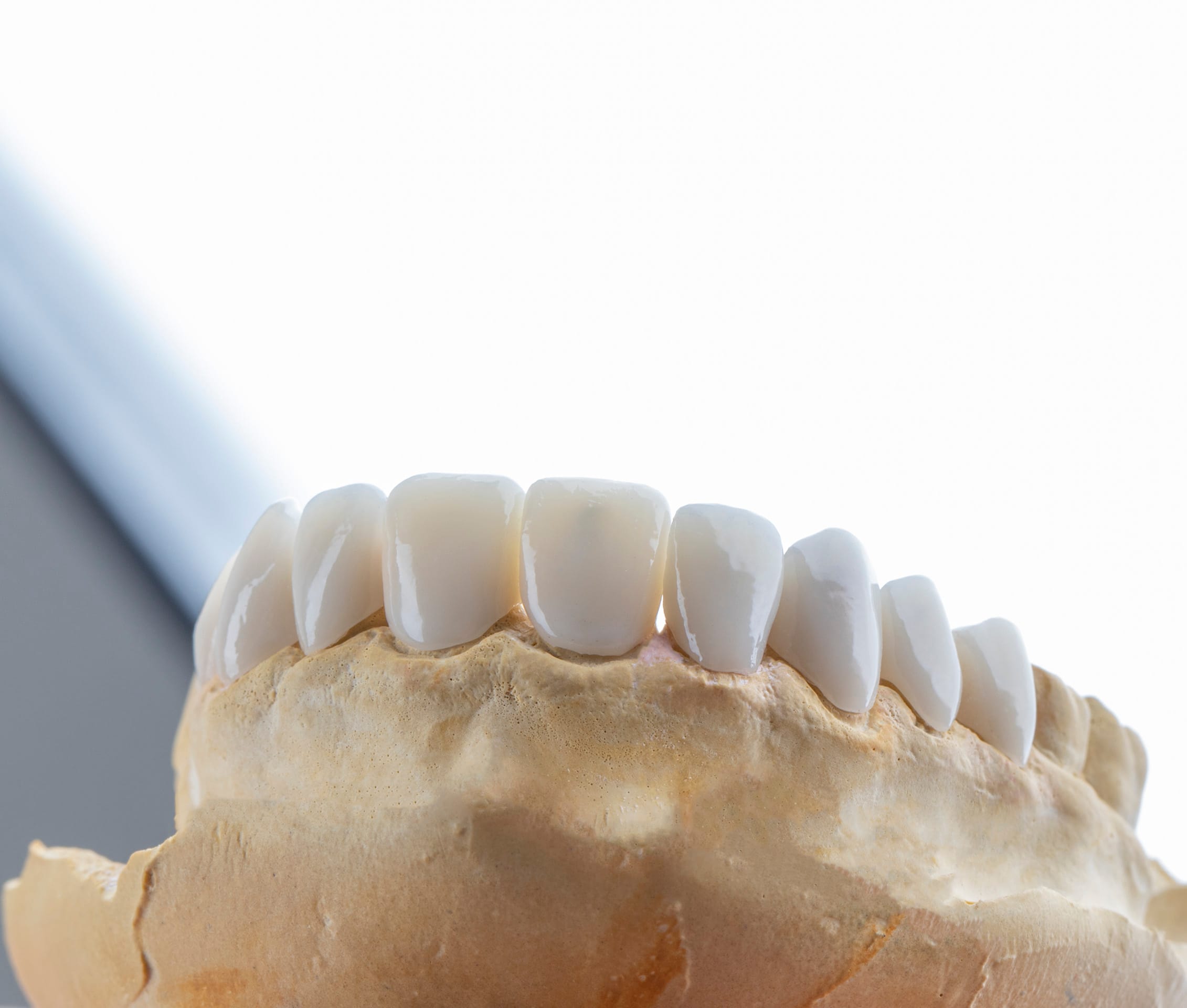 dental_veneers
