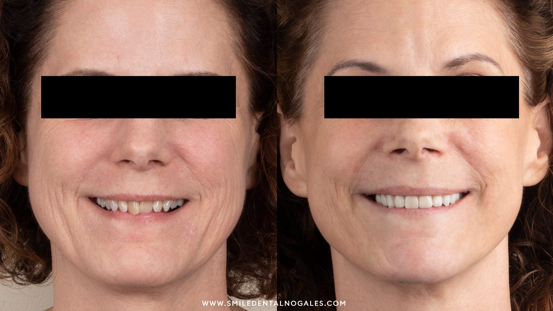 thin_veneers_patient_smiledental