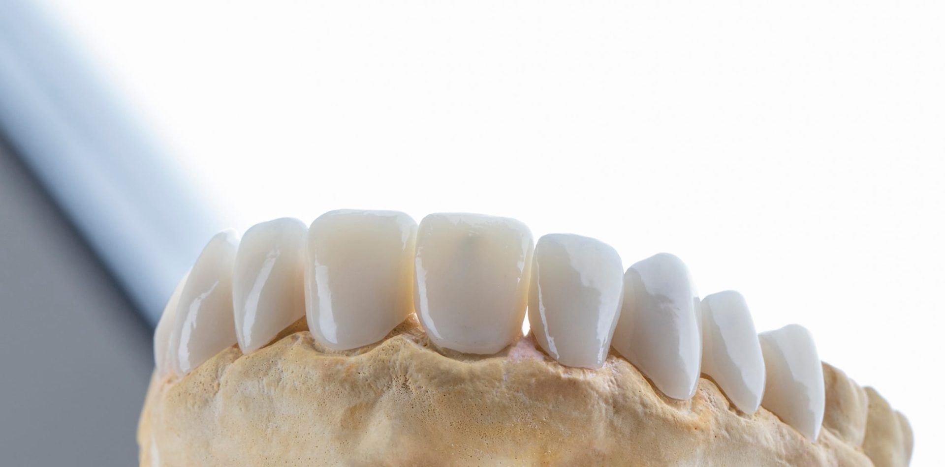 dental_veneers